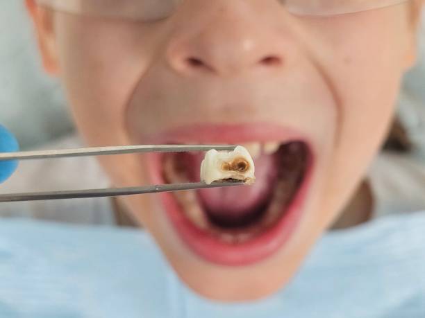 Best Emergency Tooth Extraction in La Homa, TX